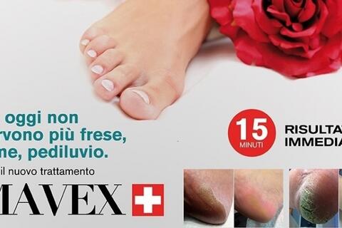 Foot callosity treatments by Calluspeeling MAVEX